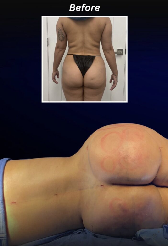 En el recuadro superior ("Before"), se muestra la espalda y glúteos de una persona de pie en ropa interior quirúrgica. En la imagen principal, se observa la zona lumbar y los glúteos de la persona recostada de lado, mostrando marcas circulares rojas sobre la piel tras un tratamiento.