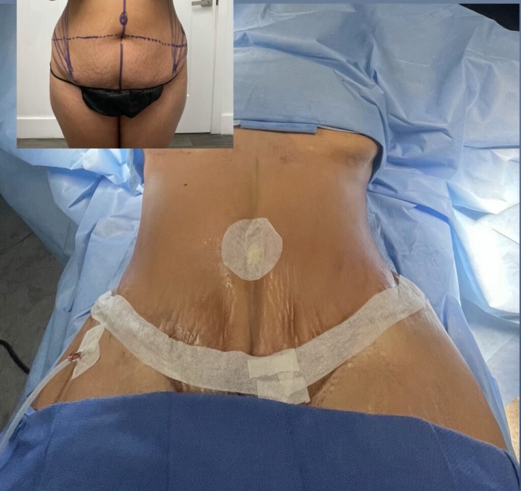 antes y duespués de la cirugia de liposuccion