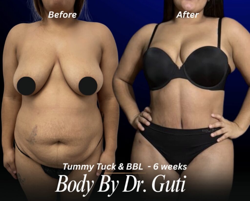 Antes y después de la abdominoplastia y la cirugía BBL.