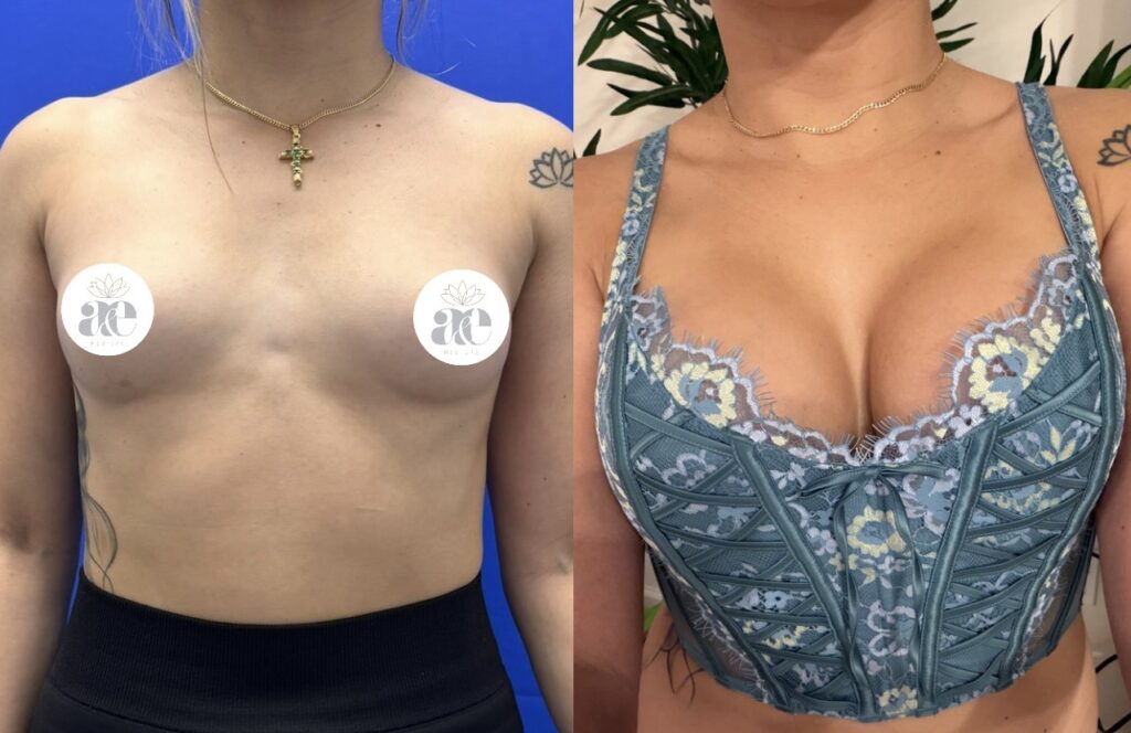 antes y después de una cirugía de aumento de senos