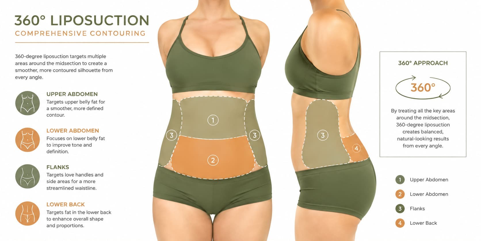 Diagrama médico de las zonas tratadas en una lipo 360: abdomen, flancos y espalda baja